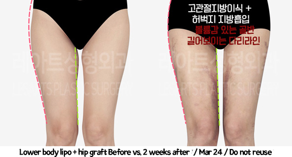 thigh_liposuction_02_231thigh_iposuction-hip_fat_grafting_07_01231226215