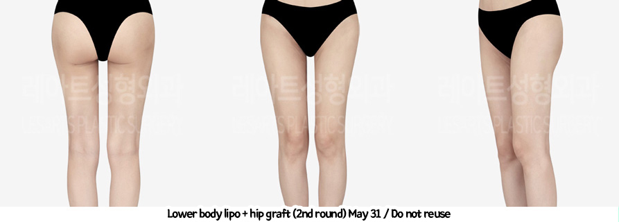 thigh_liposuction_02_231thigh_iposuction-hip_fat_grafting_08_01231226215