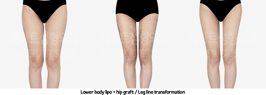 thigh_liposuction_02_231thigh_iposuction-hip_fat_grafting_09_01231226215