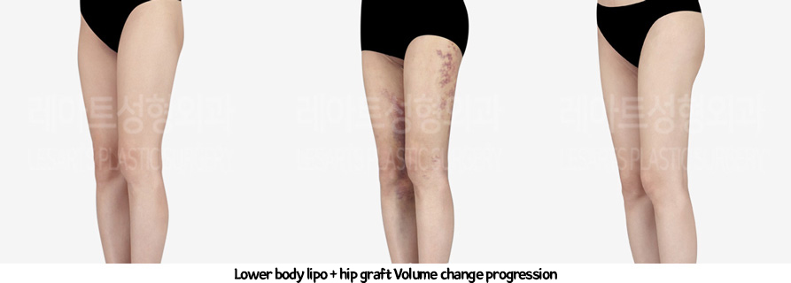thigh_liposuction_02_231thigh_iposuction-hip_fat_grafting_11_01231226215