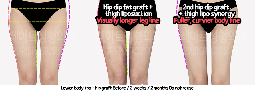 thigh_liposuction_02_231thigh_iposuction-hip_fat_grafting_12_01231226215