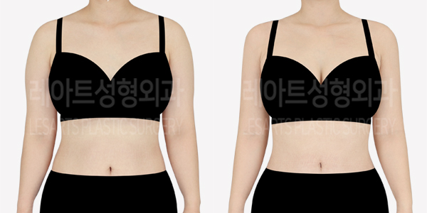 upper_body_liposuction_01_thumbnail_240610