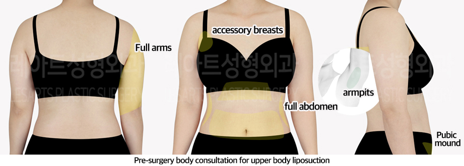 upper_body_liposuction_02_01_240610