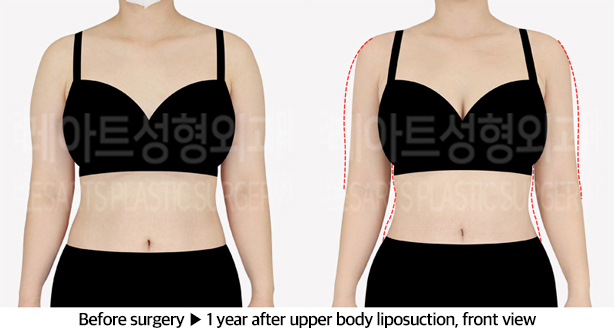 upper_body_liposuction_02_02_240610