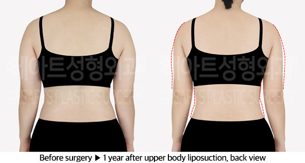 upper_body_liposuction_02_03_240610