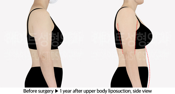 upper_body_liposuction_02_04_240610