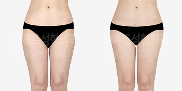 hip fat grafting_liposuction_01_thumbnail_240201