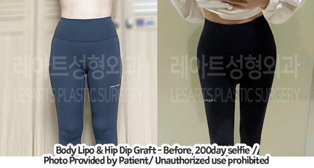 upper&lower_liposuction_02_01_240201