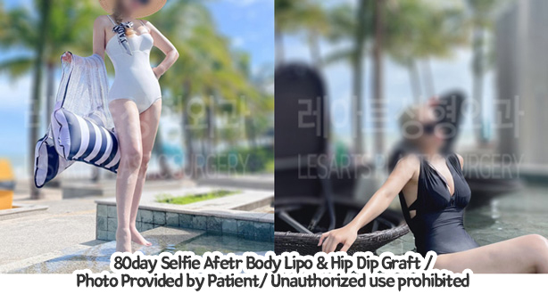 upper&lower_liposuction_02_02_240201