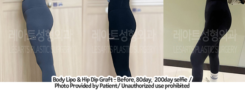 upper&lower_liposuction_02_03_240201