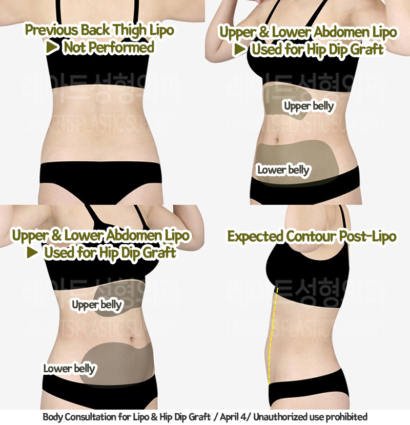 upper&lower_liposuction_02_05_240201