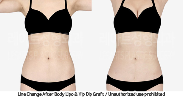 upper&lower_liposuction_02_08_240201