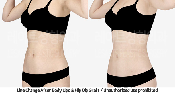 upper&lower_liposuction_02_09_240201