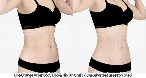 upper&lower_liposuction_02_10_240201