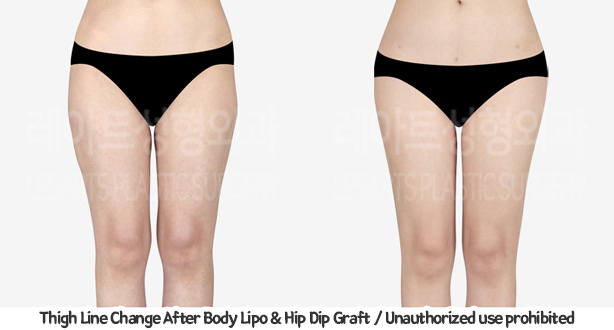 upper&lower_liposuction_02_12_240201