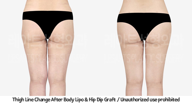 upper&lower_liposuction_02_13_240201