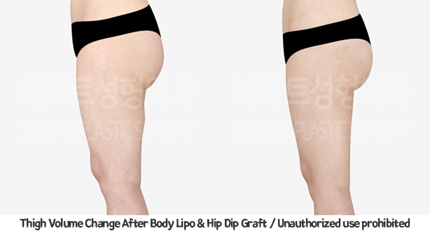 upper&lower_liposuction_02_14_240201