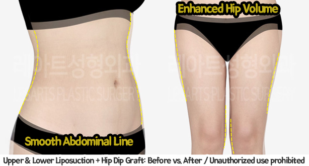 upper&lower_liposuction_02_15_240201