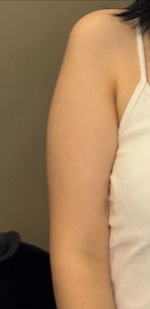 Before arm liposuction of Bbongbbongo in Korea—sleeveless white top, upper arm looks thick and round.