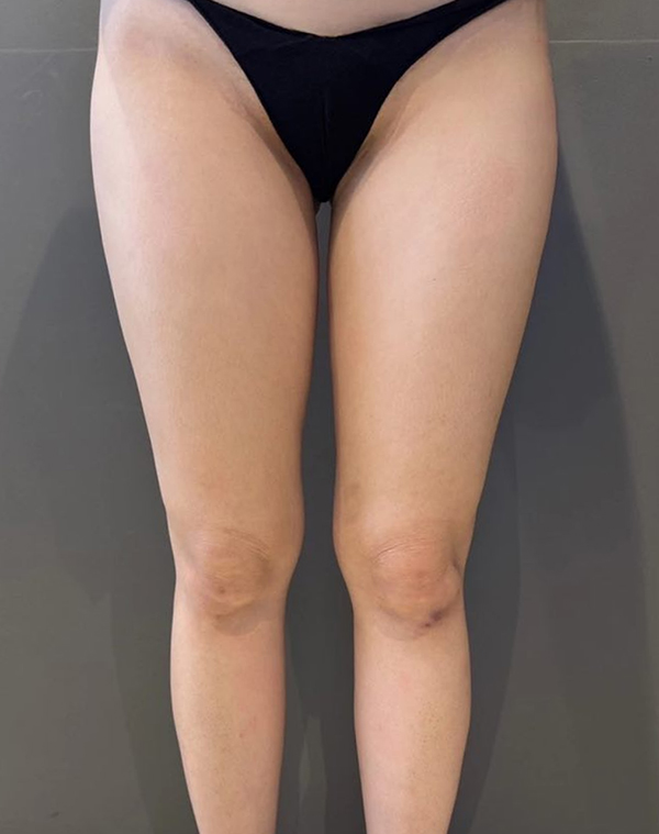 Before photo of Bebibebibaby’s thighs before liposuction in Korea, showing thick legs and tight inner thigh area.