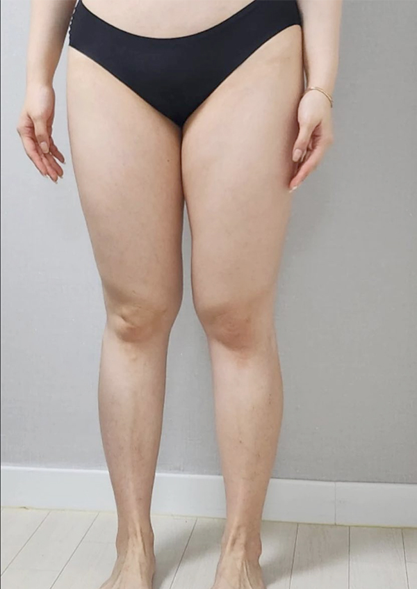 Before photo of Ceerri’s thighs before liposuction in Korea, showing thick legs with touching inner thighs.