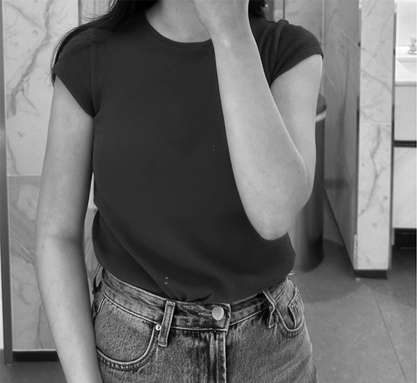 After arm liposuction of Cheer_y in Korea—wearing black t-shirt and jeans, arm looks defined and slim.
