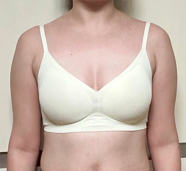 Before arm liposuction of Cheer_y in Korea—front view in white bra, arms appear thick with underarm volume.