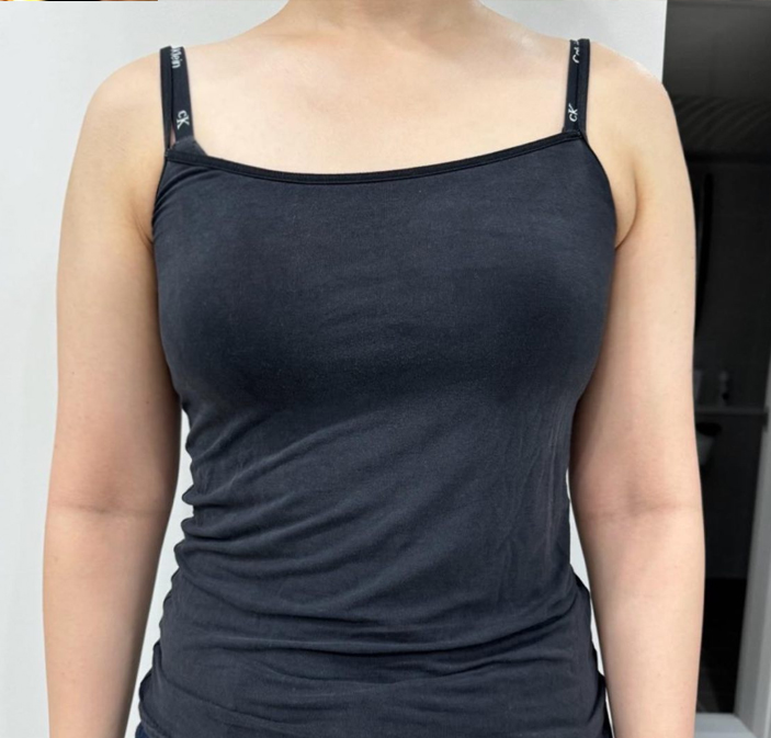 Before arm liposuction photo of Daldalijoa, showing thick upper arms before surgery at Lesarts Plastic Surgery in Korea.