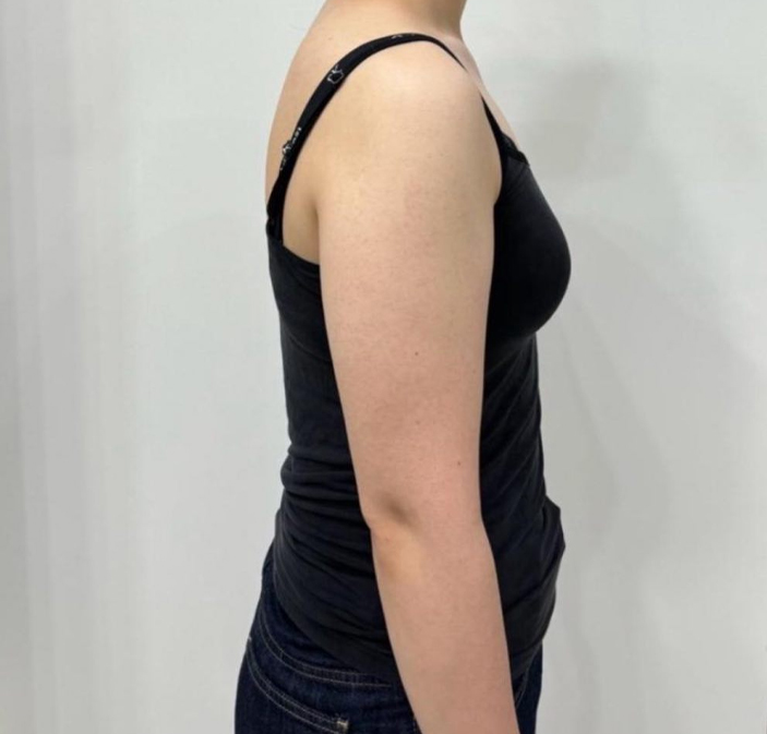 Daldalijoa’s pre-op arm photo showing excess fat and bulkiness in the upper arms before liposuction in Seoul.