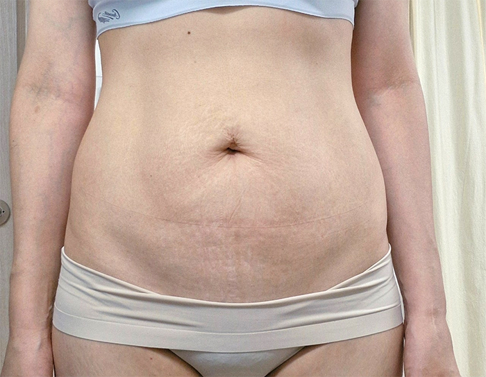 Before tummy tuck of DaonC in Korea—front view in beige underwear, lower belly sag and abdominal fold visible.