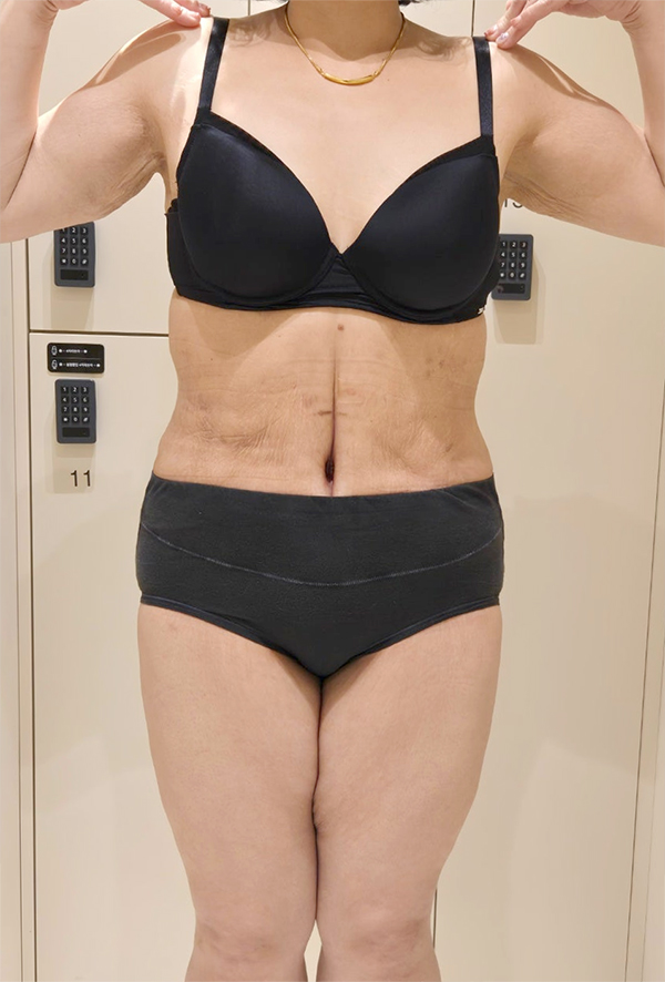 After tummy tuck of Dasitaeeonayana in Korea—front view in black bra and panties, flat abdomen and defined waistline.