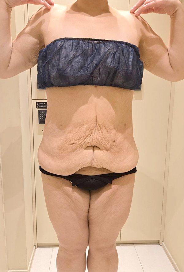 Before tummy tuck of Dasitaeeonayana in Korea—front view with sagging abdominal skin after extreme weight loss.
