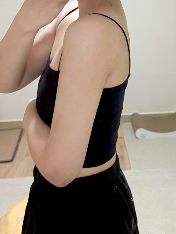 After arm liposuction of Gangidongi in Korea—side pose shows toned upper arm and natural muscle definition.