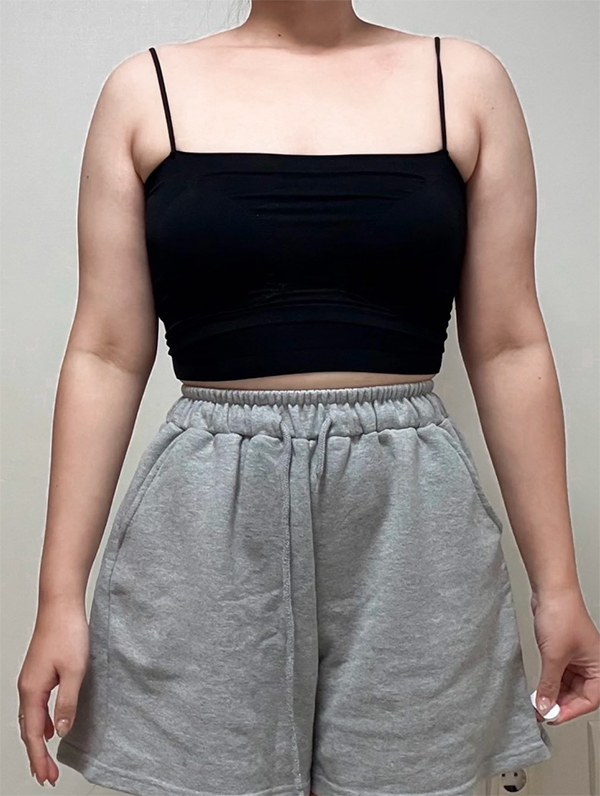 Before arm liposuction of Gangidongi in Korea—front view in black top and gray shorts, arms look bulky and rounded.