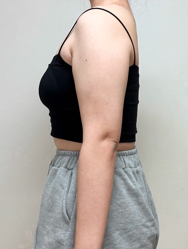 Before arm liposuction of Gangidongi in Korea—side view shows thick upper arm with undefined shoulder line.