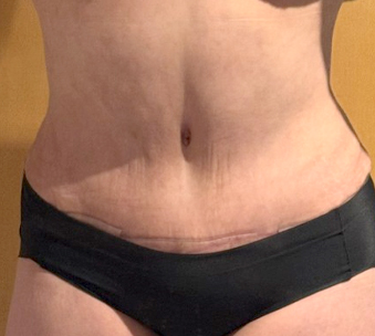 Close-up after tummy tuck of Geumgunggeum in Korea—tightened abdomen with natural-looking navel.