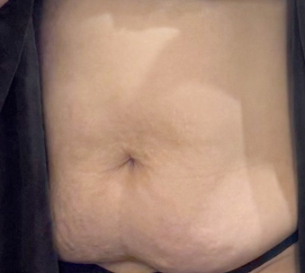 Before tummy tuck of Geumgunggeum in Korea—front view with sagging abdominal skin and deep belly folds.