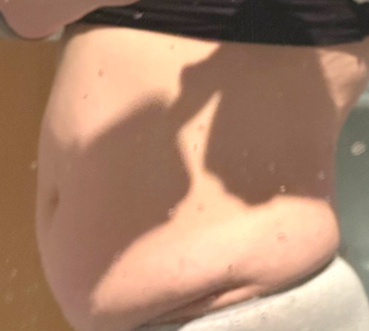 Side view before tummy tuck of Geumgunggeum in Korea—bulging lower belly with significant skin laxity.