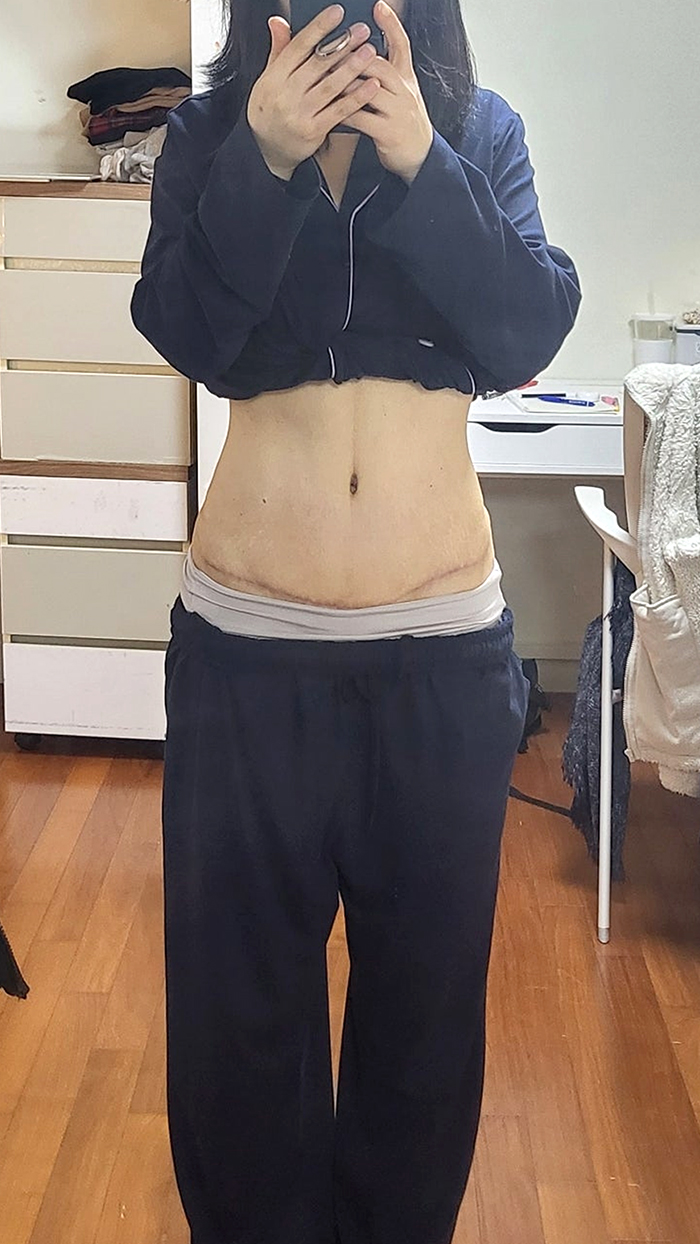 After tummy tuck of Geuraeoneulun in Korea—hoodie lifted to show toned abs, tight waistline clearly defined.
