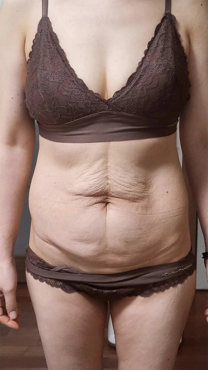 Before tummy tuck of Geuraeoneulun in Korea—standing in bra and underwear, sagging abdominal skin and fat folds visible.