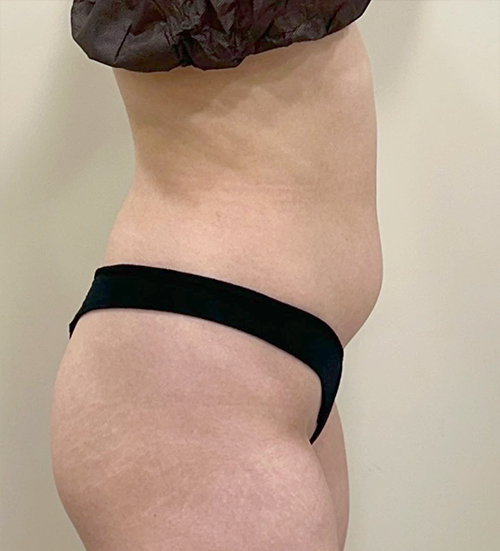 Before hip fat transfer of Hari in Korea—side view, protruding abdomen and flat hip line.
