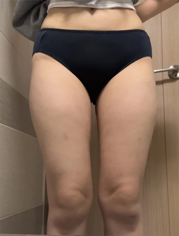 Before thigh liposuction and buttocks fat transfer of Hari in Korea—front view in dark underwear, thighs appear thick and hips unshaped.