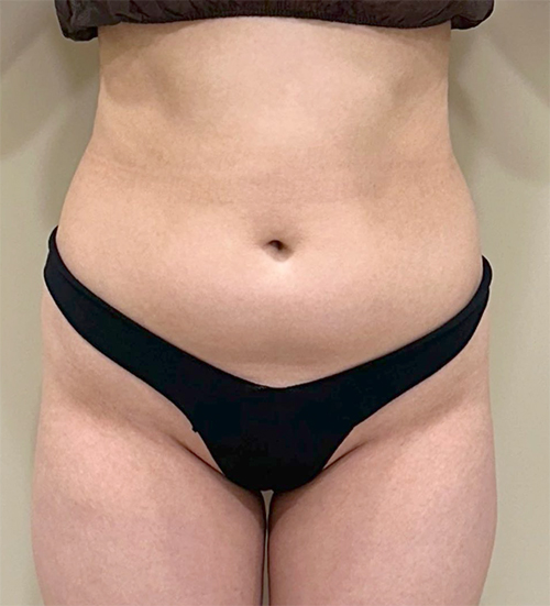 Before abdominal liposuction of Hari in Korea—front view with visible lower belly bulge and undefined waist.