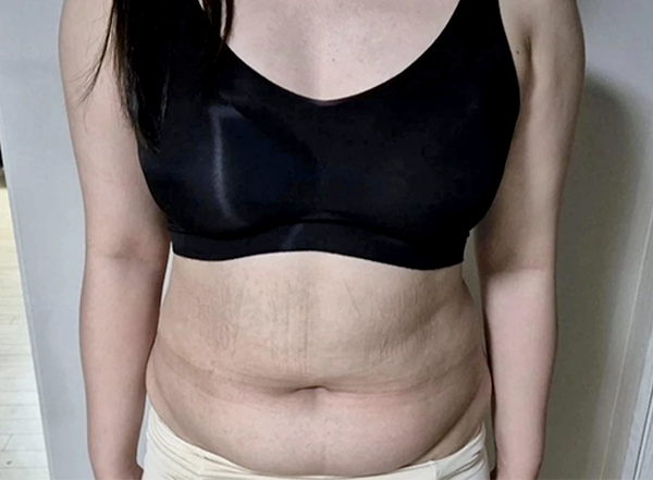 Before arm and abdominal liposuction of Hihehohihe in Korea—front view with visible belly fat.