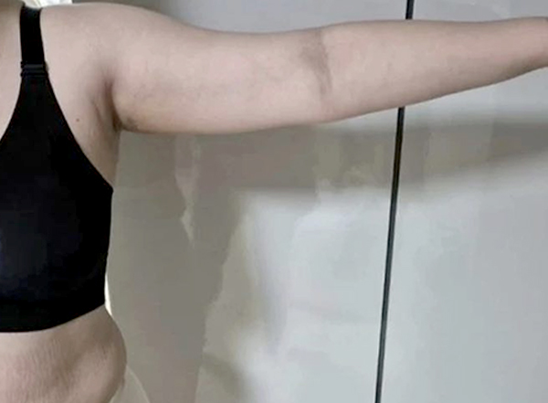 Before arm liposuction of Hihehohihe in Korea—side view with sagging upper arm fat.