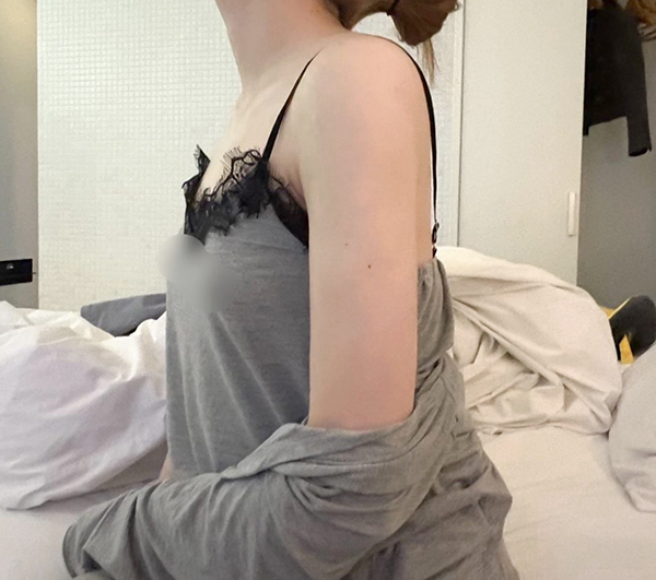 After photo of Hiiiiiichama in a sleeveless top, highlighting her slim, defined upper arms post-liposuction.