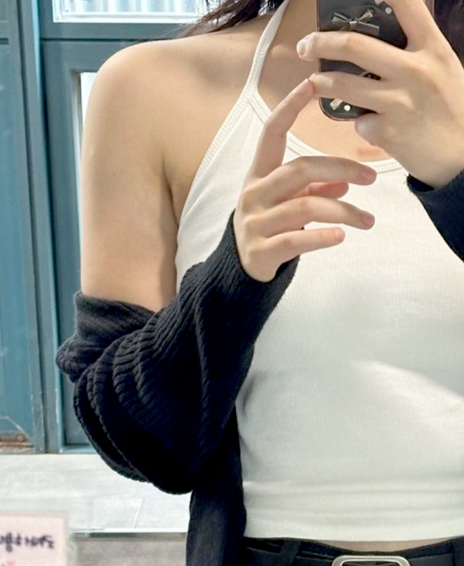 After arm liposuction and thigh liposuction photo of Izziring, 8 weeks post-op with slimmer legs and reduced upper arm volume at Lesarts.