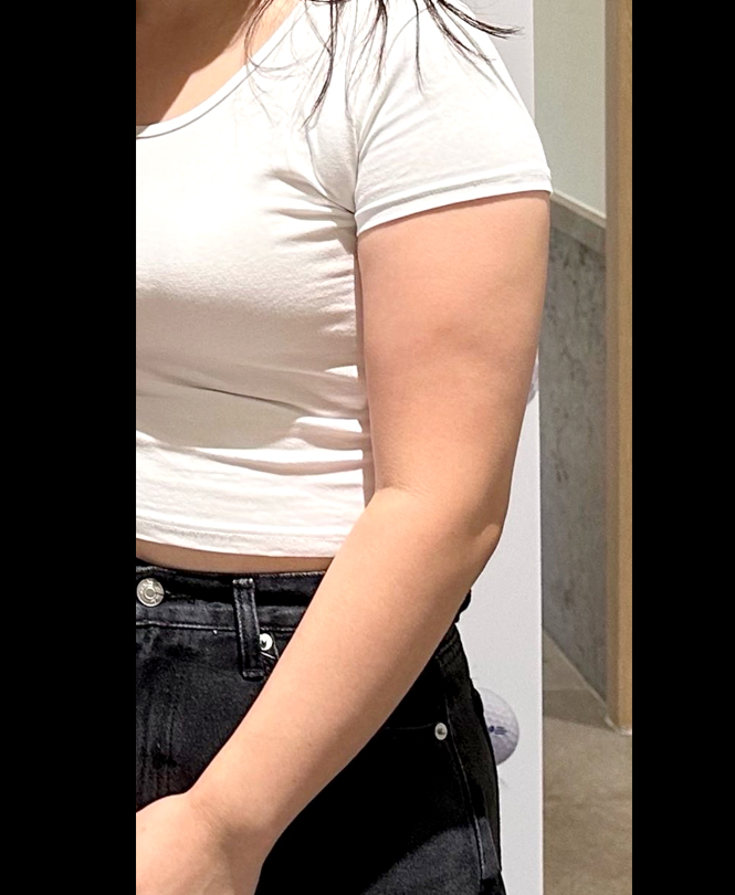 Before arm and thigh liposuction photo of Izziring, showing visible upper arm fat before surgery at Lesarts in Korea.