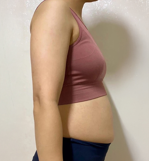 Side and back view before liposuction showing excess arm and abdominal fat