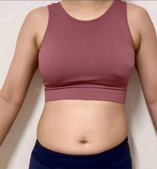 Front view before arm and abdominal liposuction by Janzanjjanjjan at Lesarts Plastic Surgery in Korea
